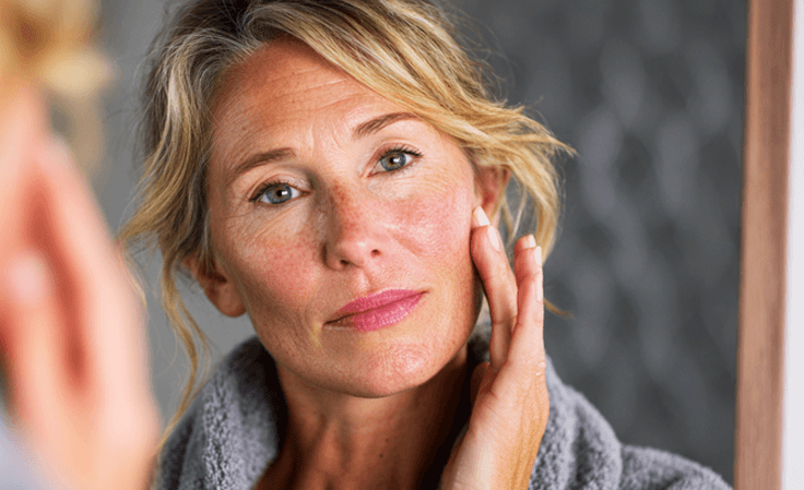 natural rosacea remedies